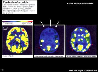 cervello consumatore di cocaina