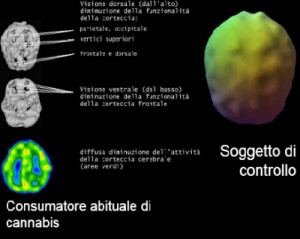 cervello consumatore di cannabis